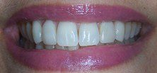 Porcelain Veneers results at Barataria Dental