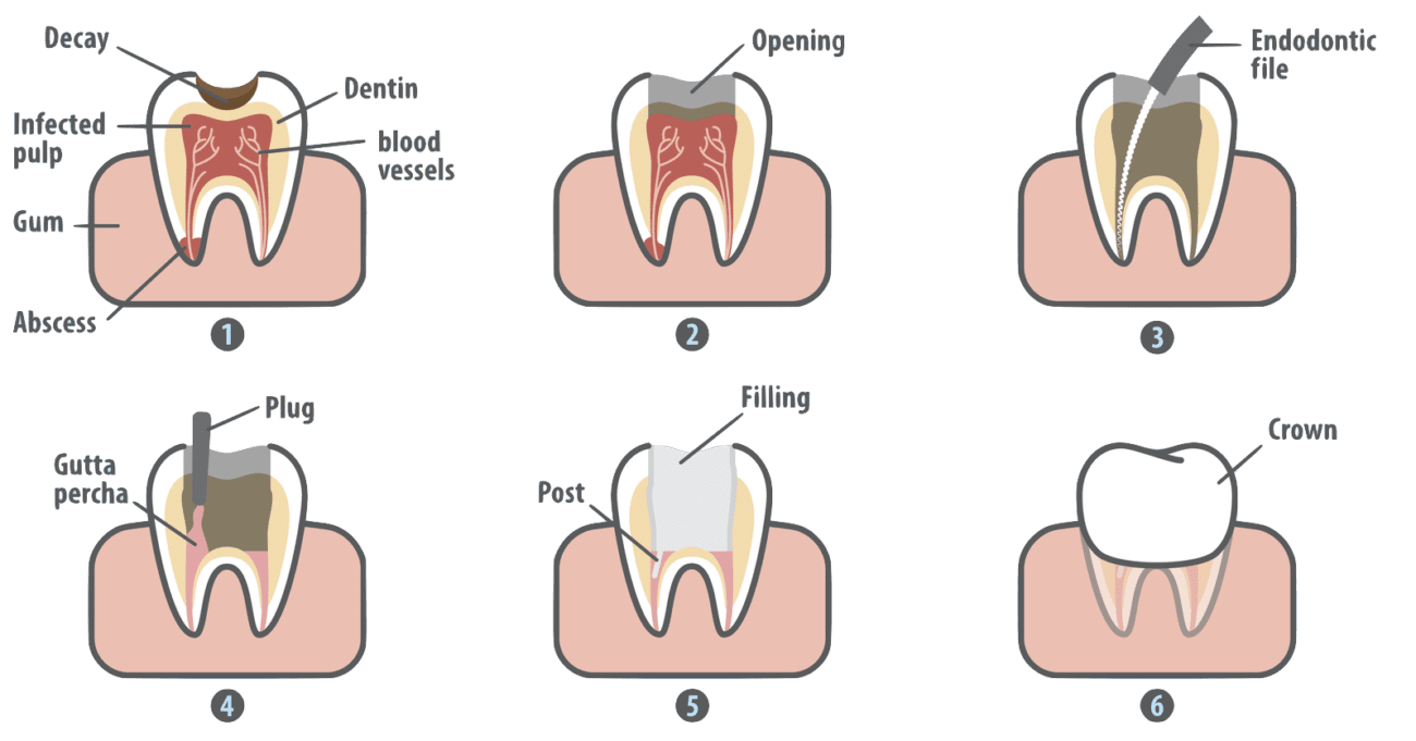 Root Canal Treatment marrero la