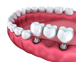 dental implant secured bridge marrero la