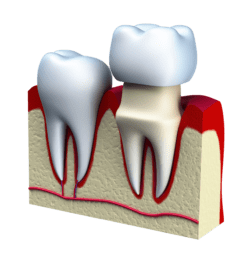 dental crown marrero la dentist office