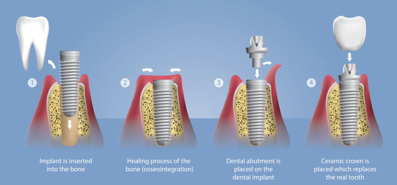 dental implant procedure marrero la