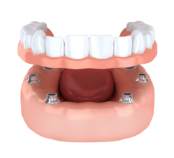 dental implant secured denture new orleans la