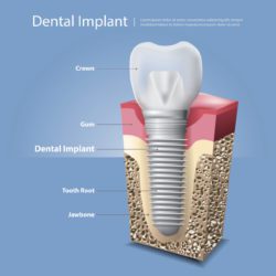 Three benefits of dental implants marrero la