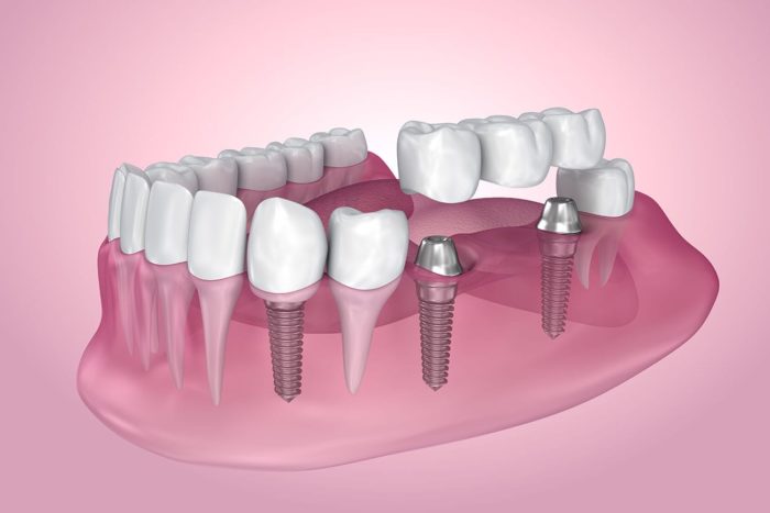 dental implants marrero la