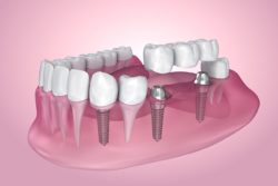 types of dental implants in Marrero Louisiana