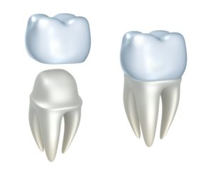 dental crown treatment Marrero Louisiana