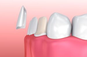 Enhance Your Smile with Veneers