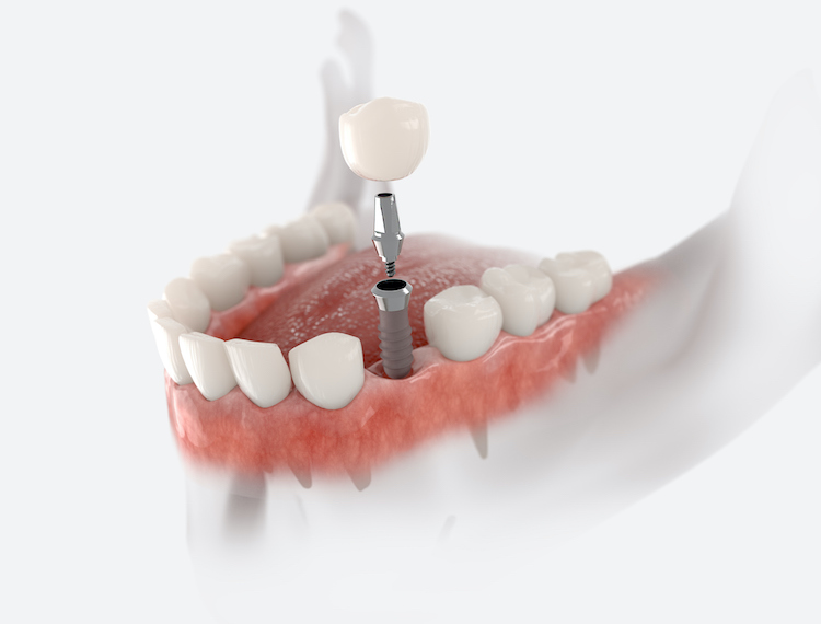 Dental implants offer numerous advantages over traditional tooth replacement options, making them a preferred choice for many patients.